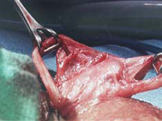 Vasectomy reversal - vas deferens