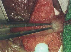 Vasectomy-reversal - patency is confirmed