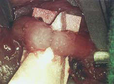 Vasectomy reversal - micro-sutures